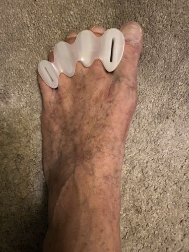 Customer photo review of Correct Toes®