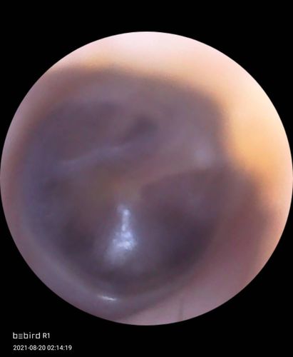 Customer photo review of Bebird™ Intelligent Earwax Removal Otoscope