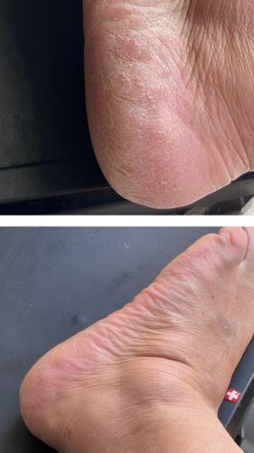 Customer photo review of LOVASKIN INSTANT FOOT PEEL Deluxe Kit - 25 Beauty treatments