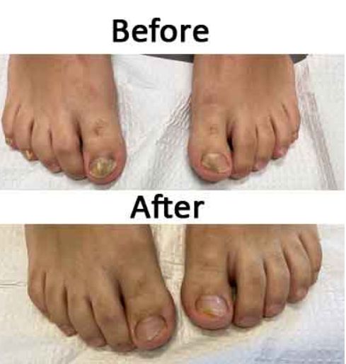 Customer photo review of Onychonil Nail Paint