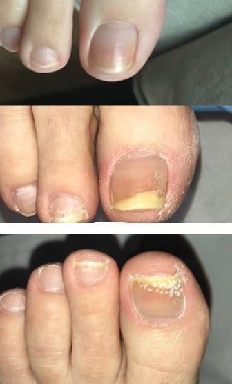 Customer photo review of Onychonil Nail Paint