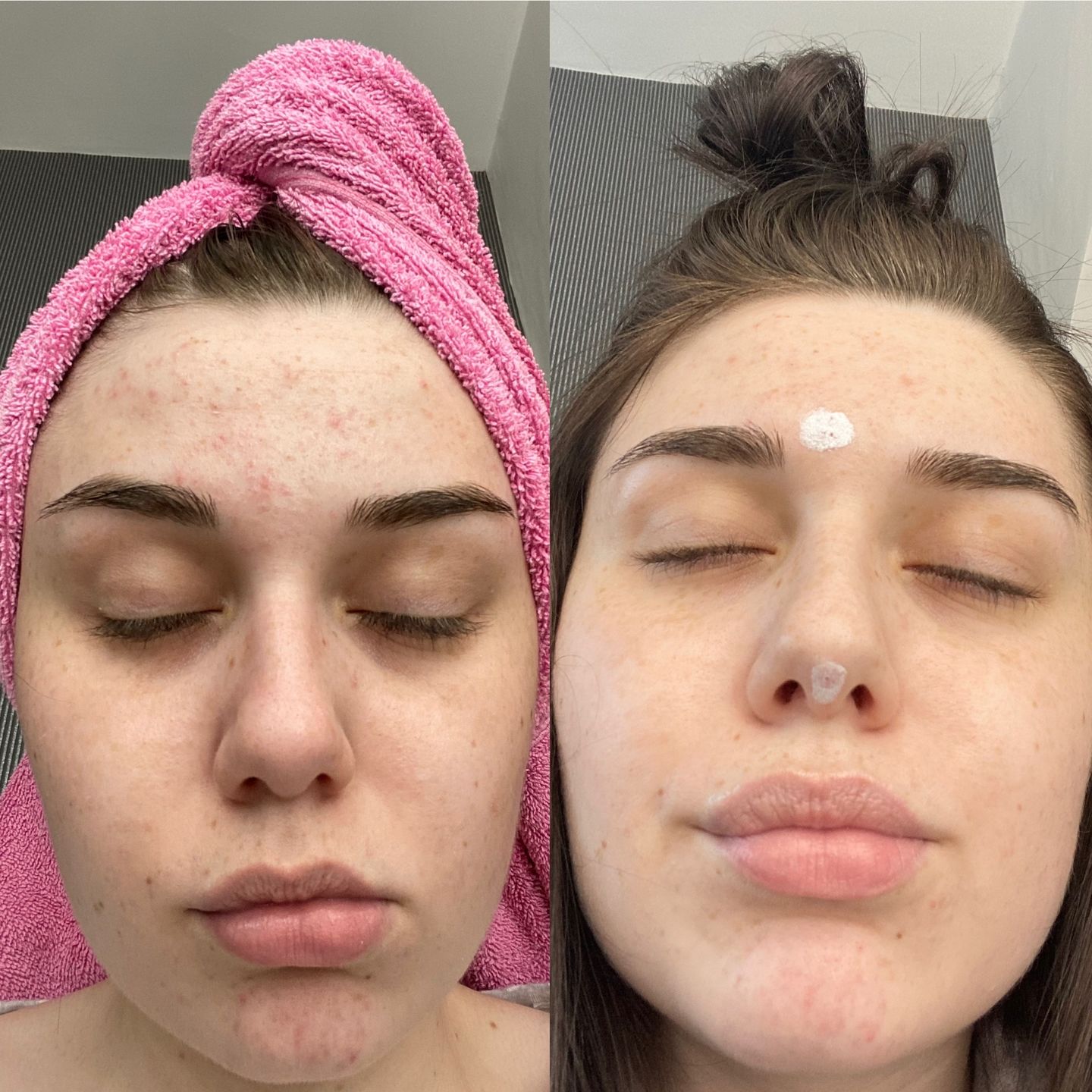 Customer photo review of Antiac Daily Face Wash