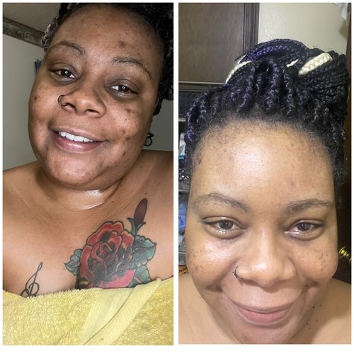 Customer photo review of BERRI-CLEAR+ 5 BERRY SUPERFRUIT SERUM