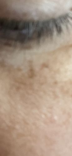 Customer photo review of Dermavel - Solo Kit