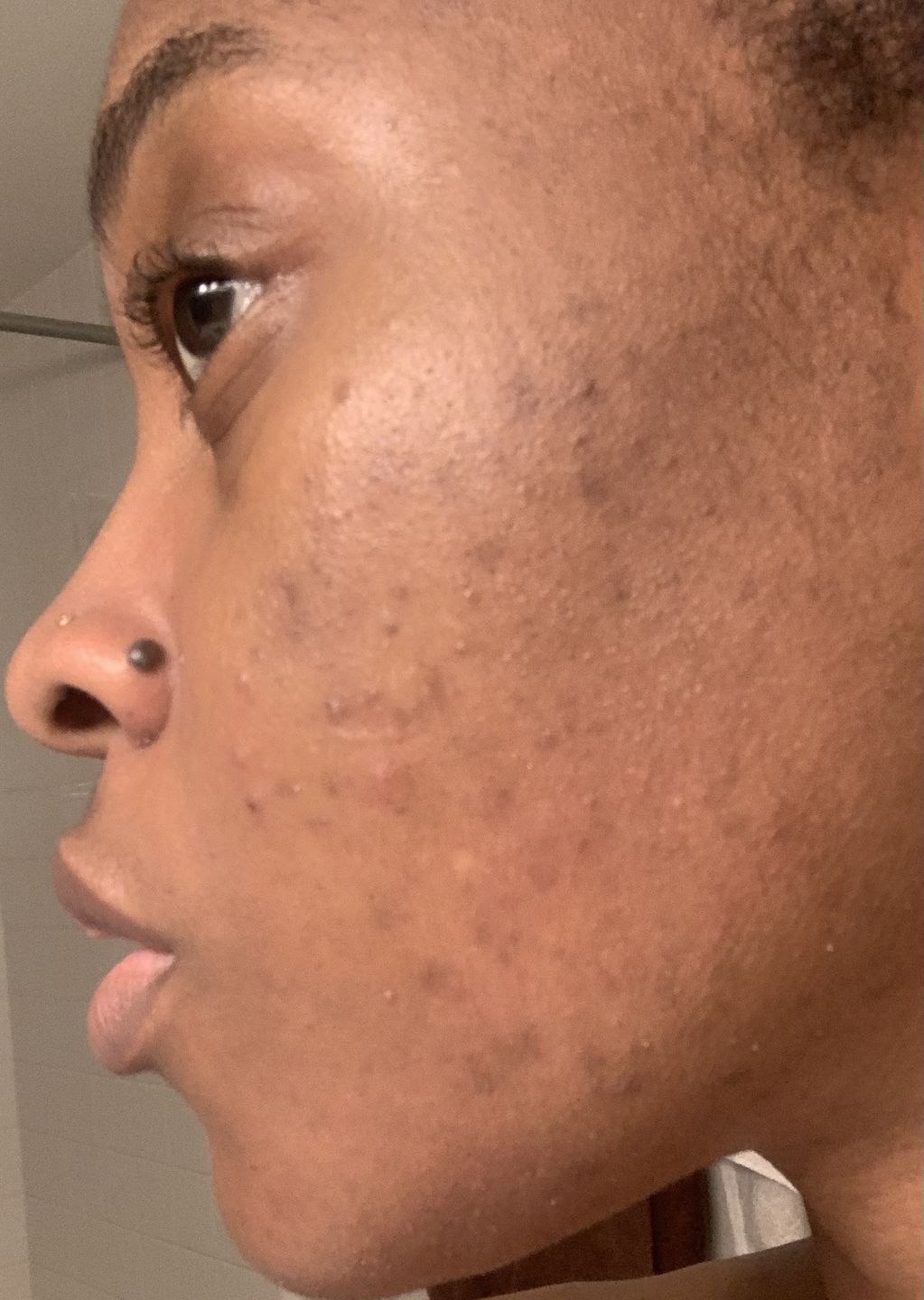 Customer photo review of Bolden Clear Skin Travel Kit