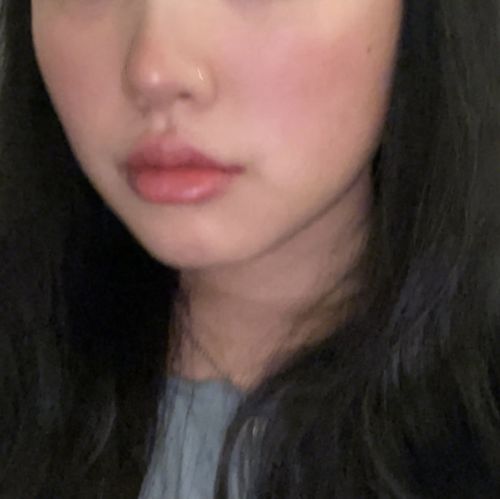 Customer photo review of CheekFix: Buccal Fat Reduction