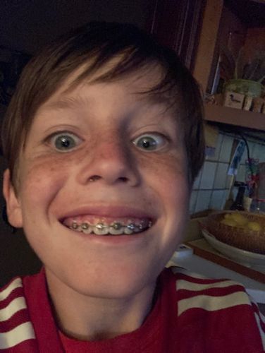 Customer photo review of SUPER TEETH Dental Probiotic 60 Count