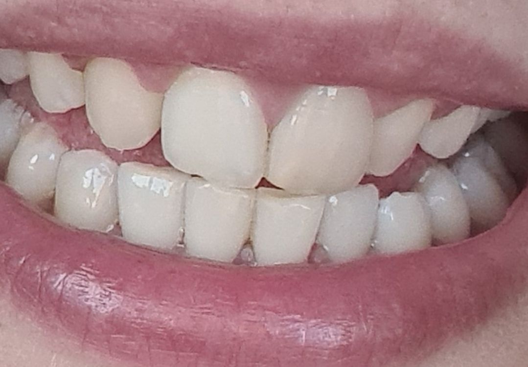 Customer photo review of Whites Non-Peroxide Teeth Whitening Kit