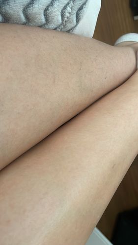 Customer photo review of Depilador Nuva Skin®