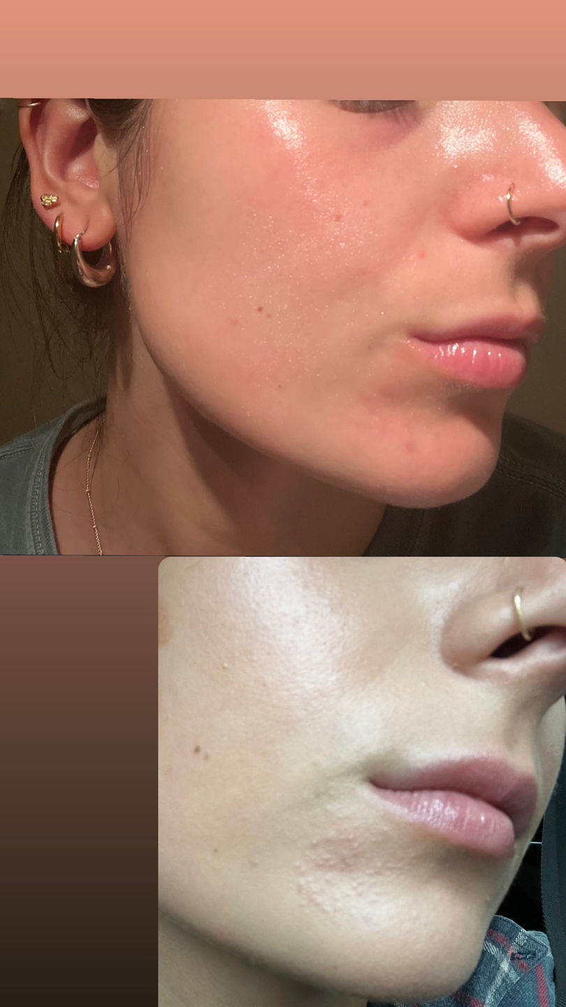 Customer photo review of Resurfacing Botanical Cleanser