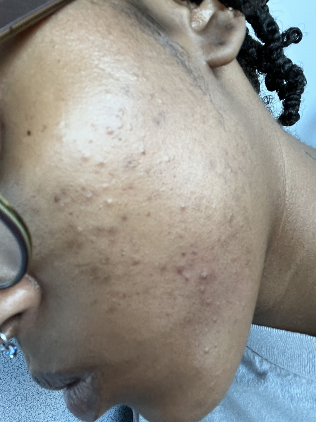Customer photo review of BERRI-CLEAR+ 5 BERRY SUPERFRUIT SERUM
