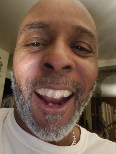 Customer photo review of Night Guard – One-time