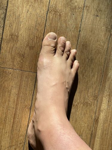 Customer photo review of Correct Toes®