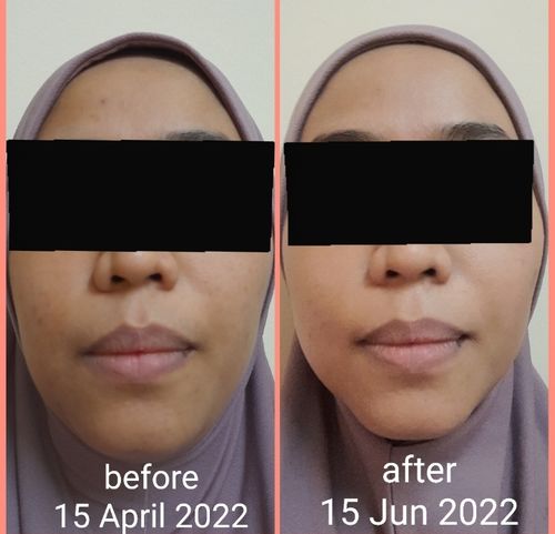 Customer photo review of GOLD SCAR REPAIR SET