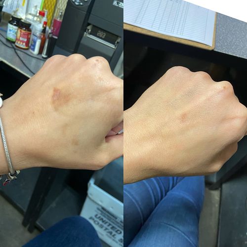 Customer photo review of DarkSpotCorrector™ 7 Dagars Mörk Fläckborttagningstvål