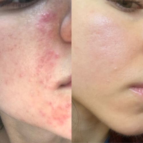 Customer photo review of Niacid