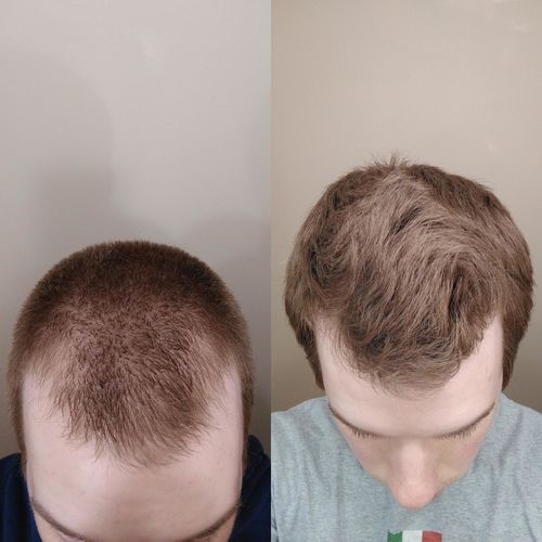 Customer photo review of BioMax™ Kam för Hårväxt