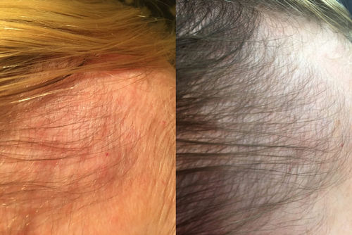 Customer photo review of BioMax™ Kam för Hårväxt