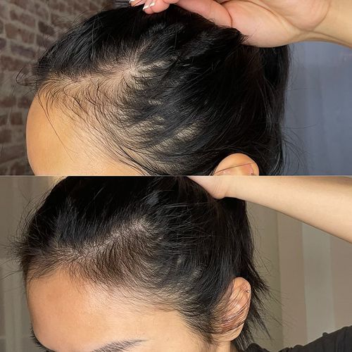 Customer photo review of BioMax™ Kam för Hårväxt