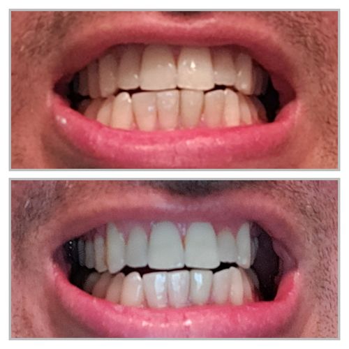 Customer photo review of Teeth Whitening Kit