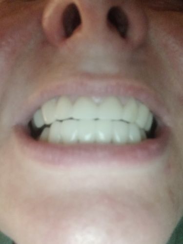 Customer photo review of Teeth-Veneer 2.0