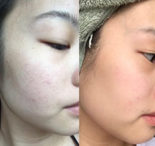 Customer photo review of Masque de nettoyage en profondeur sans pores