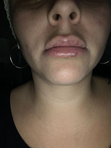 Customer photo review of LipFix: Filler