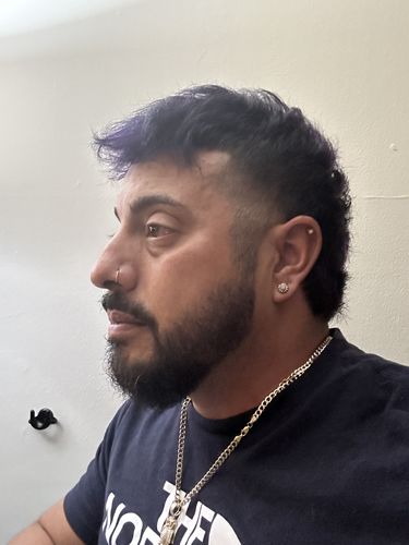 Customer photo review of 12.5% Minoxidil Extra Strength Topical Solution USP for Men.