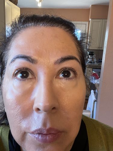 Customer photo review of EvenSkyn® Venus: Premium Eyelid Anti-Aging Device
