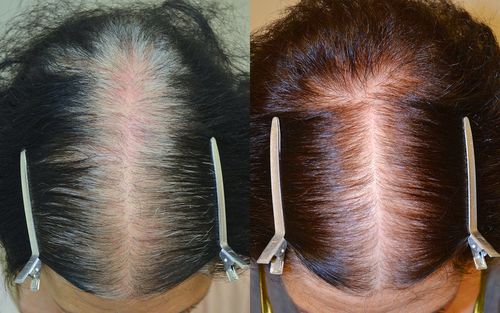 Customer photo review of Hair Growth With Argan Oil - 10 Minute Miracle - Spray Bundle