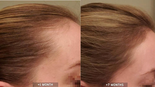 Customer photo review of Anti-Hair Loss With Argan Oil - 10 Minute Miracle - Complete Bundle