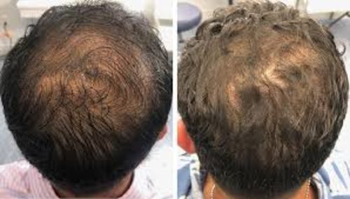 Customer photo review of Anti-Hair Loss With Argan Oil - 10 Minute Miracle - Spray Bundle
