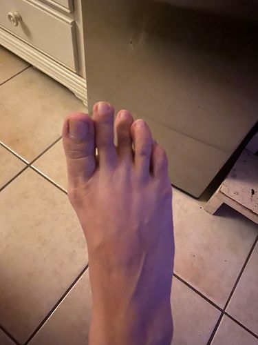 Customer photo review of FotLättnad™ Smärt Lindring Salva