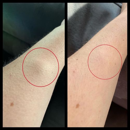 Customer photo review of LipomVård™ Fettsvulst Borttagning Kräm