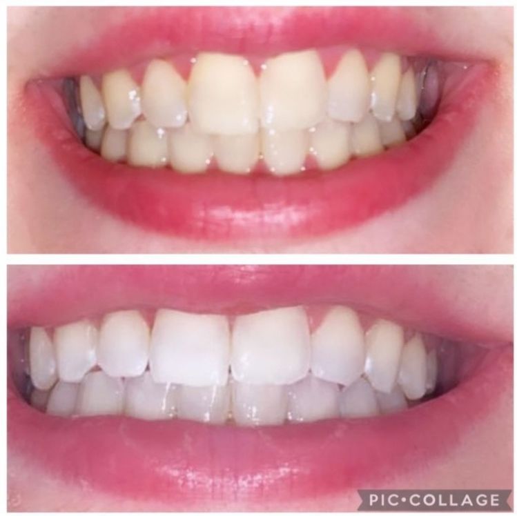 Customer photo review of Teeth Whitening Kit