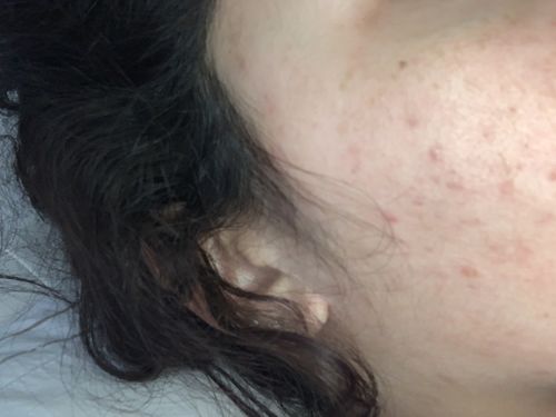 Customer photo review of Salicylsäure BHA 2% 50 ml