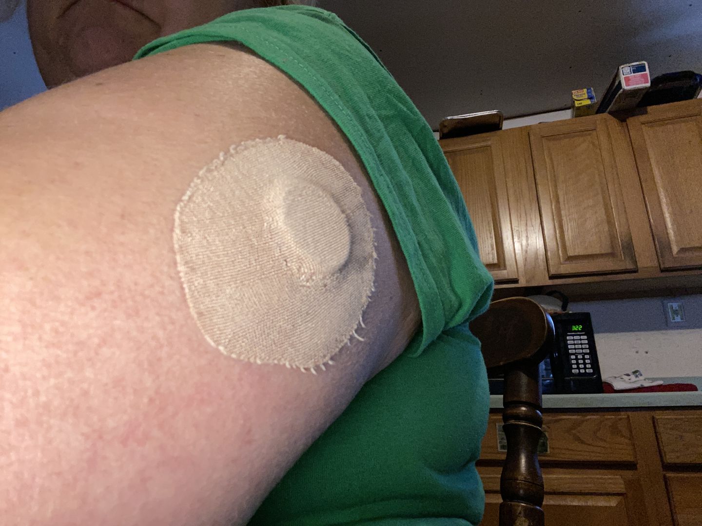 Customer photo review of Skin Grip Original - Freestyle Libre Adhesive Patches