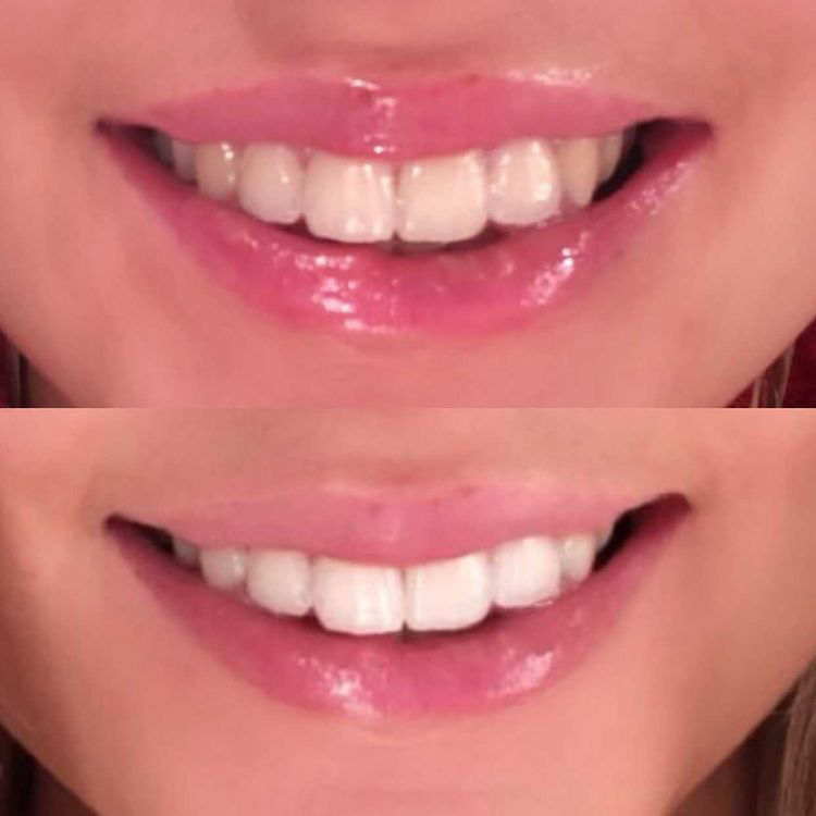 Customer photo review of Teeth Whitening Strips