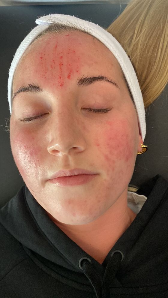 Customer photo review of Reset Skin System Dermal Needling Device