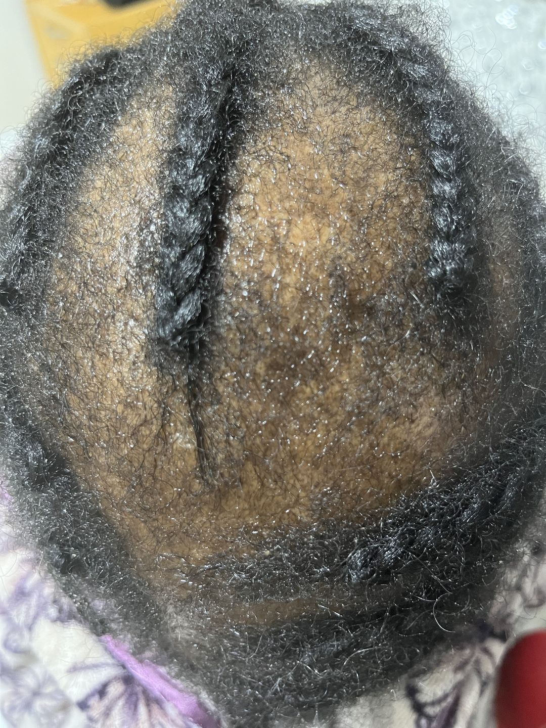 Customer photo review of Hair Recovery Bundle