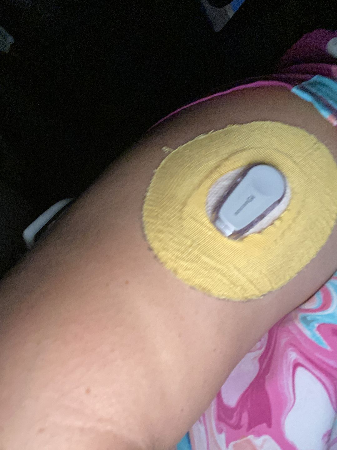 Customer photo review of Skin Grip Original - Omnipod Adhesive Patches