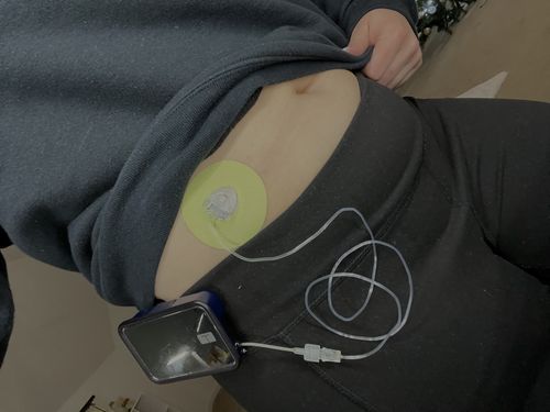 Customer photo review of Skin Grip Original - Universal Adhesive Patches (0.8 inch Hole)