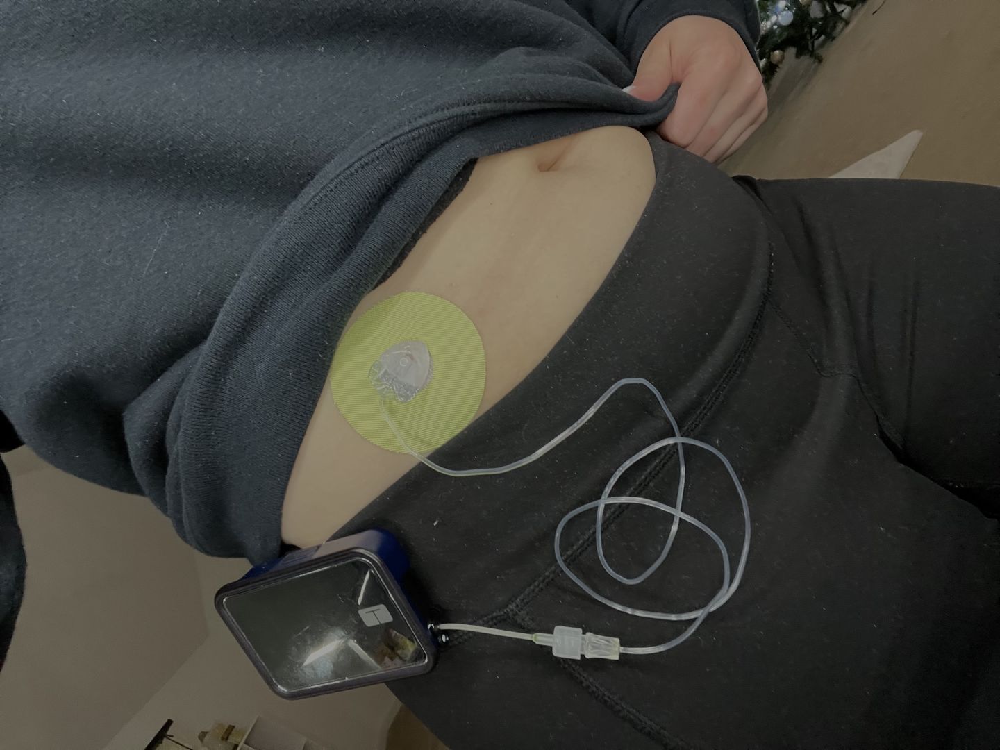 Customer photo review of Skin Grip Original - Universal Adhesive Patches (0.8 inch Hole)