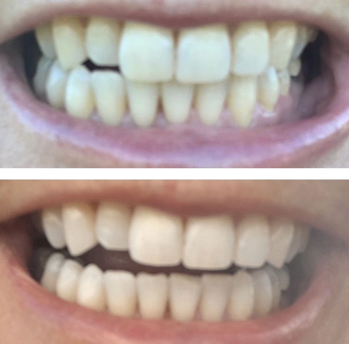 Customer photo review of Teeth Whitening Strips