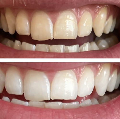 Customer photo review of Teeth Whitening Kit