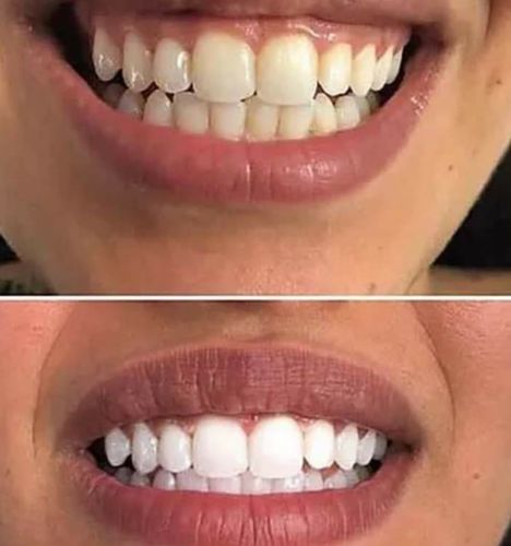 Customer photo review of Teeth Whitening Strips