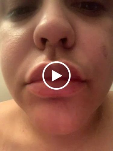 Customer video review of LipFix: Filler