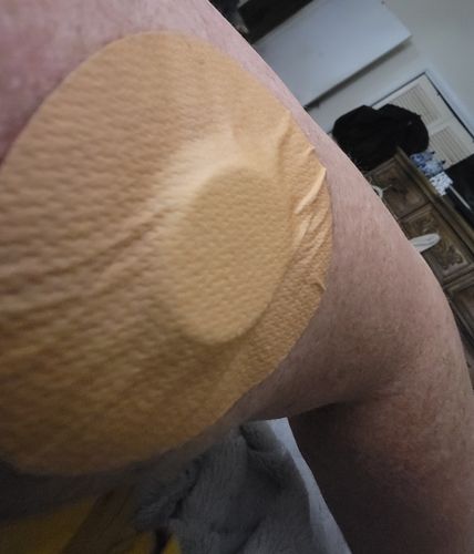 Customer photo review of Skin Grip MAX Freestyle Libre Patches