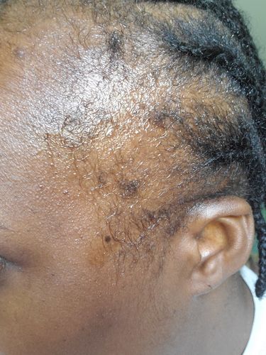 Customer photo review of Balding and alopecia