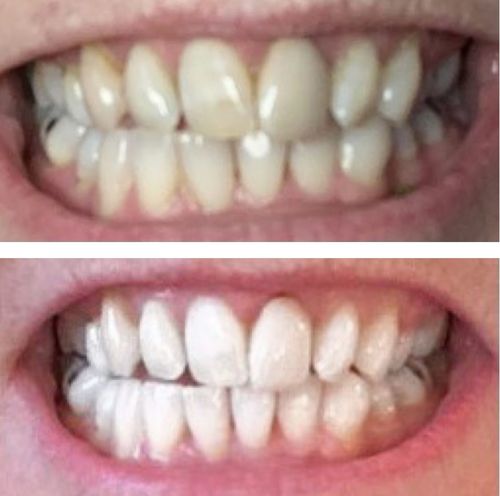 Customer photo review of Teeth Whitening Kit